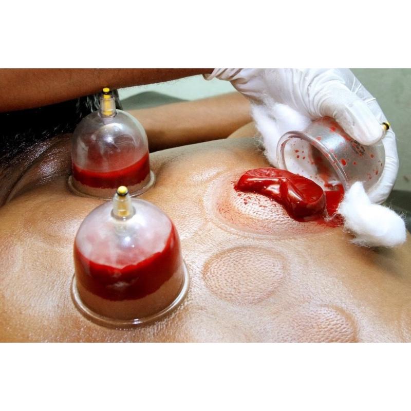 Wales Hijama Cupping for Men